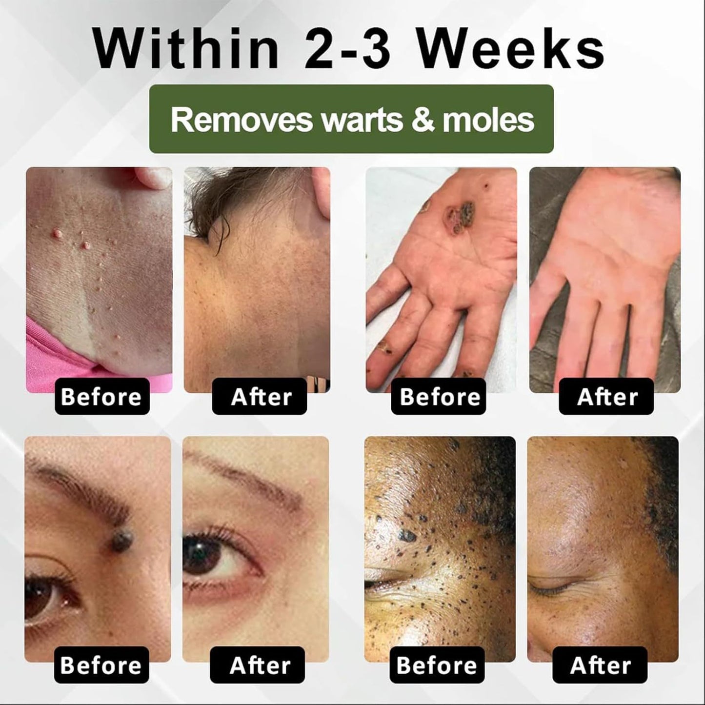 Natureerase Instant Mole Spot Removal Gel