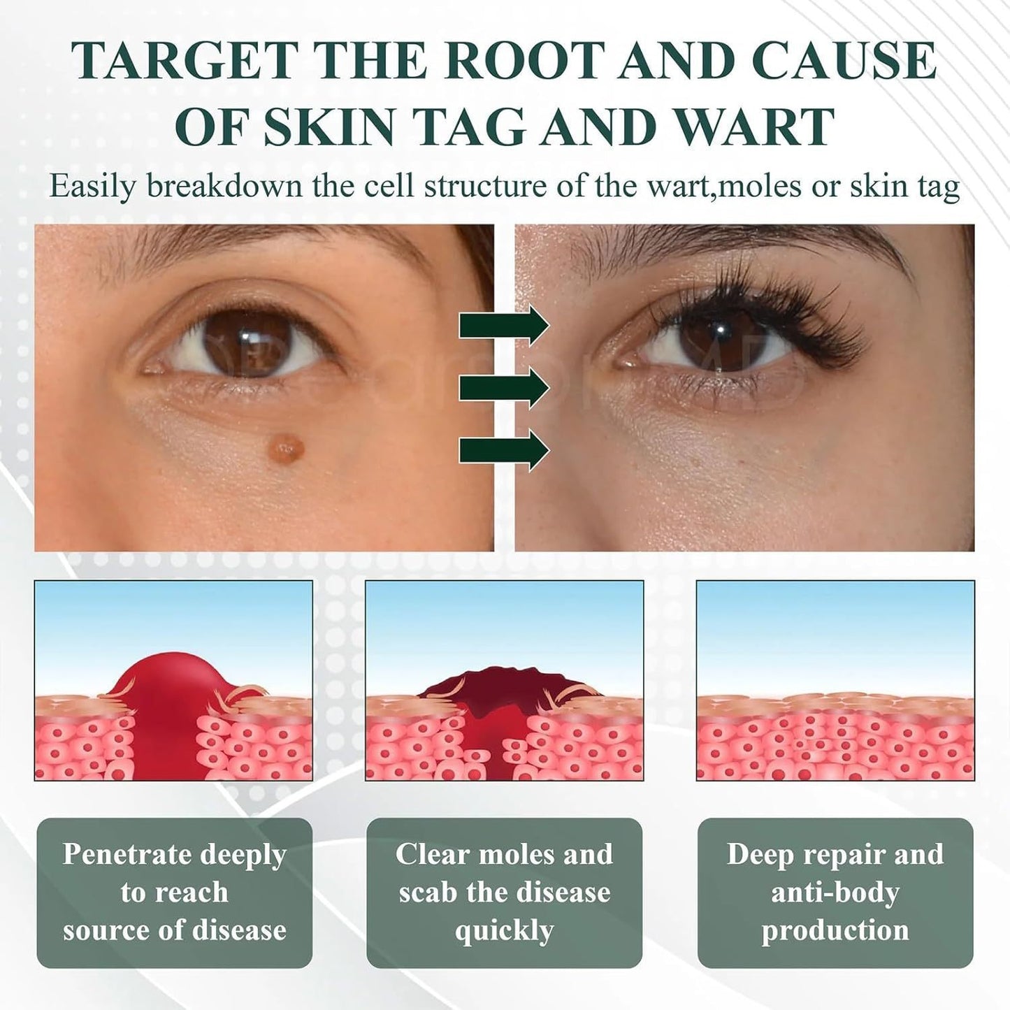 Natureerase Instant Mole Spot Removal Gel