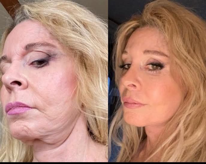 ✨Botoxmix bee venom firming serum stick🔥