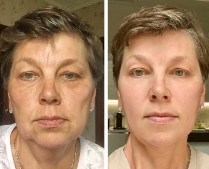 ✨Botoxmix bee venom firming serum stick🔥